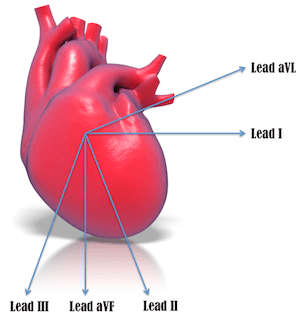 Heart with Inferior and High Lateral Leads