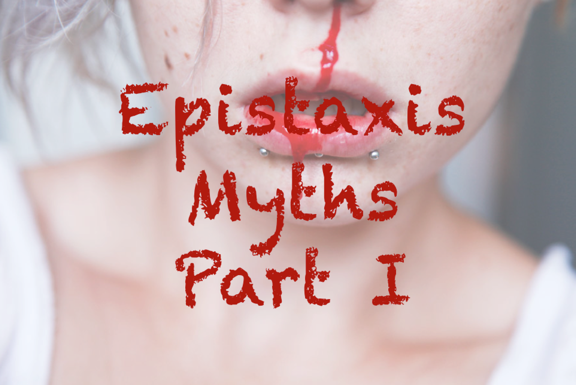 Do Patients with Epistaxis Managed by Nasal Packing Require ...