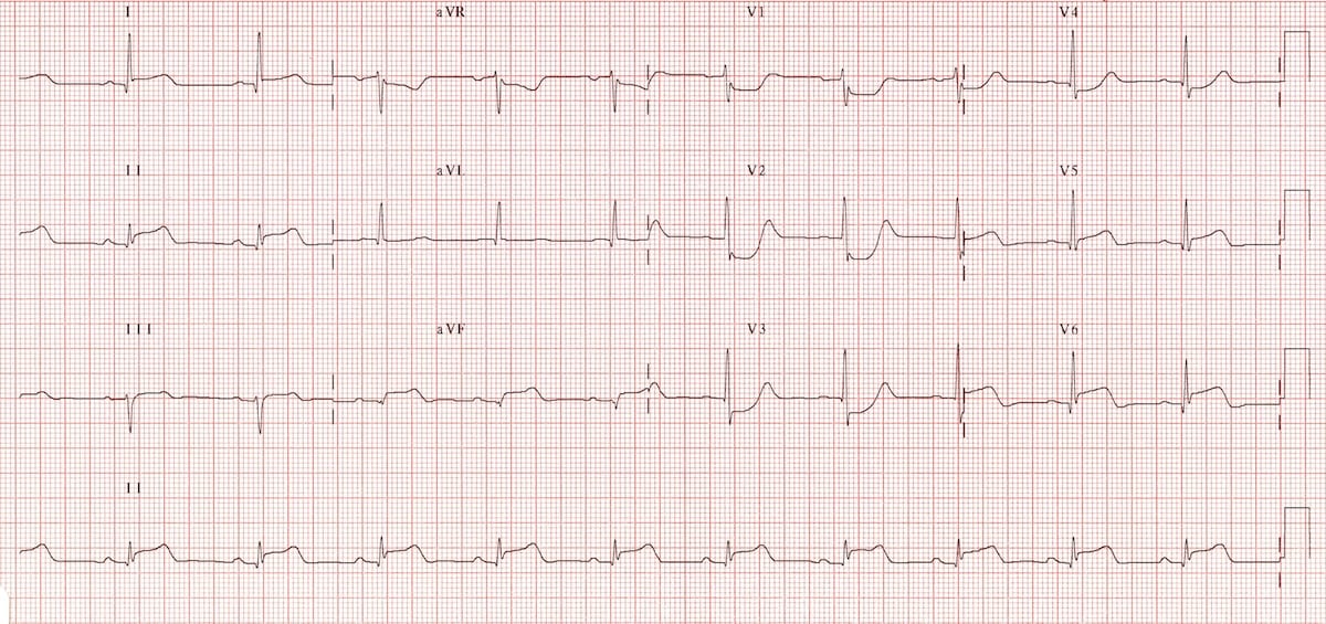 stemi-case-examples-wikidoc