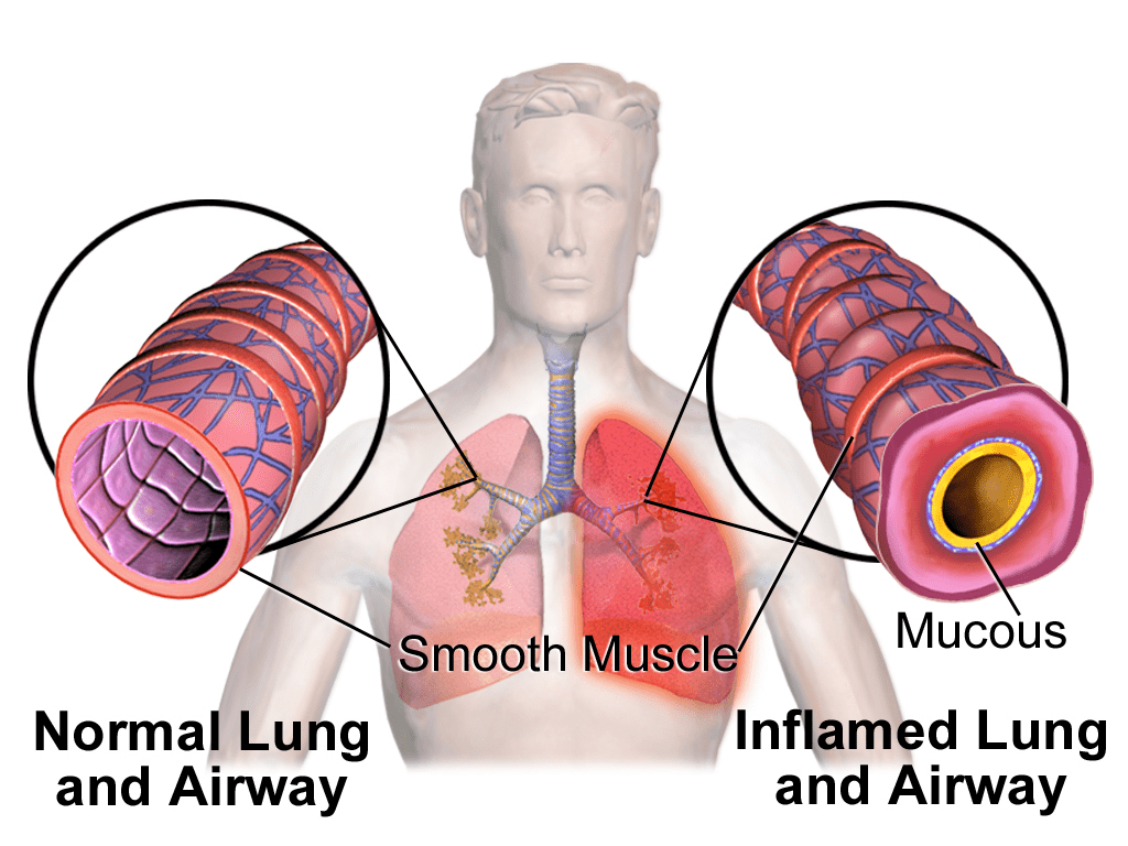 Can Bronchitis Cause Asthma