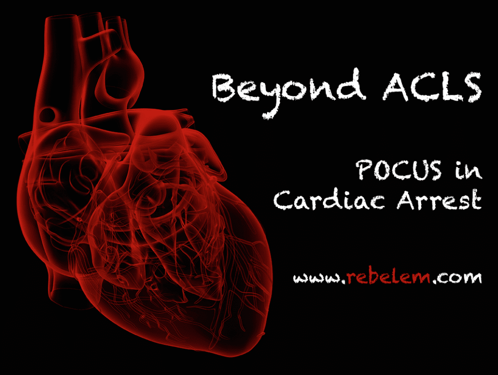 Beyond ACLS - POCUS in Cardiac Arrest