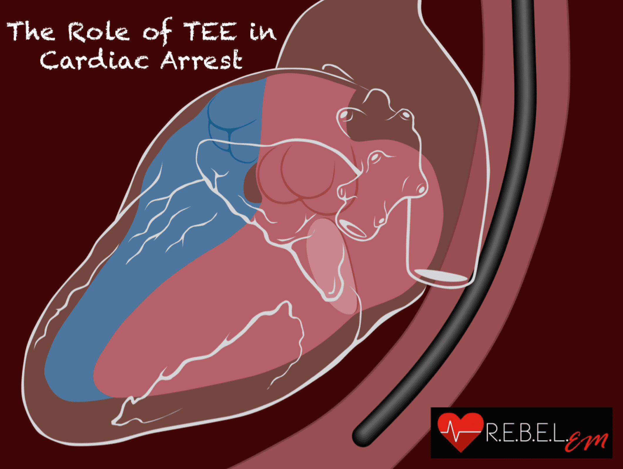 The Role of TEE in Cardiac Arrest - REBEL EM - Emergency Medicine Blog