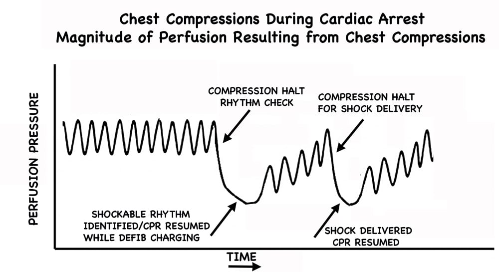 CPR WITHOUT PRE-CHARGE