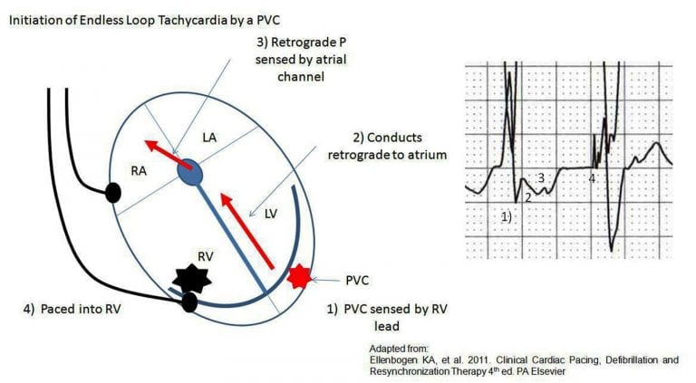 Pacemaker Basics Rebel Em Emergency Medicine Blog