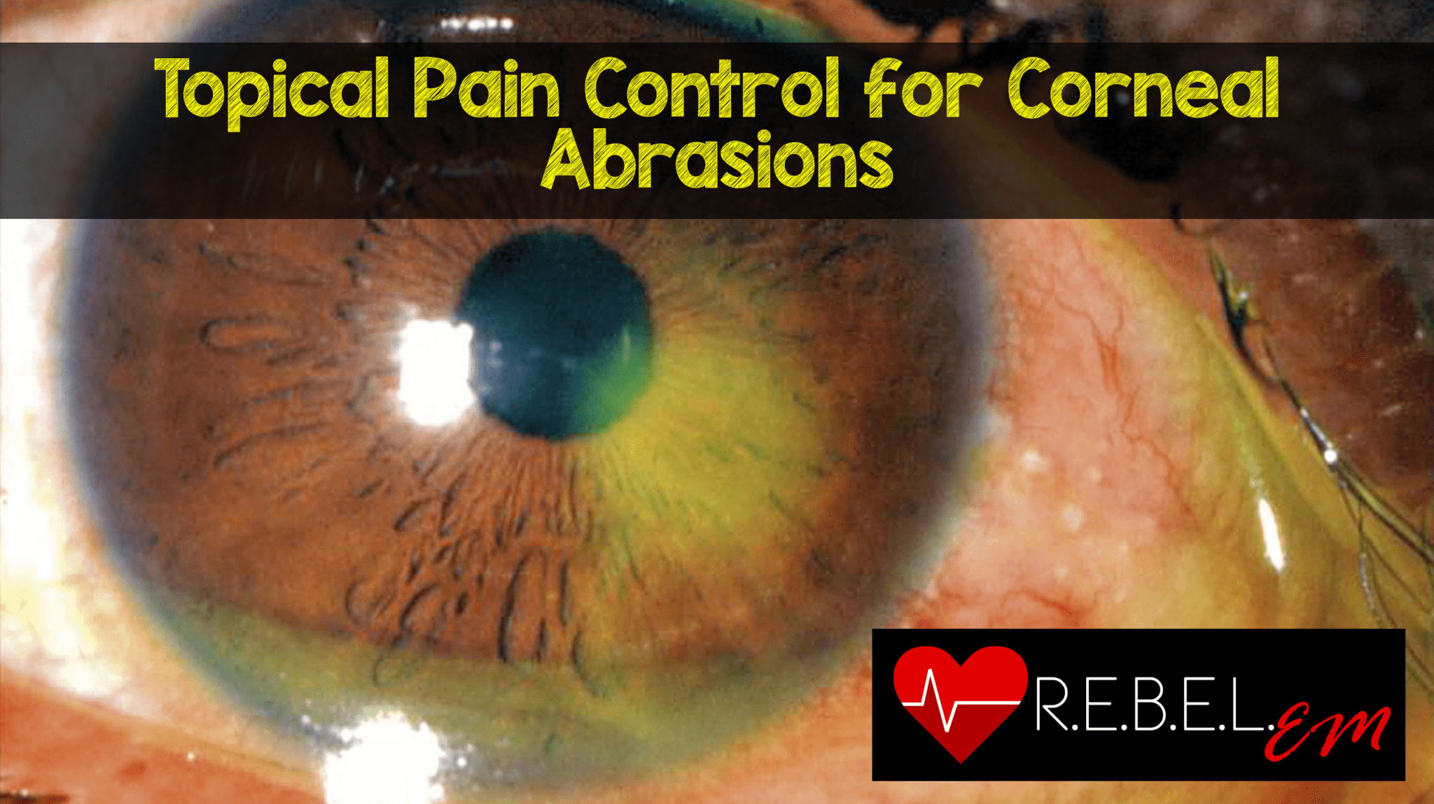 Topical Pain Control For Corneal Abrasions REBEL EM Emergency 