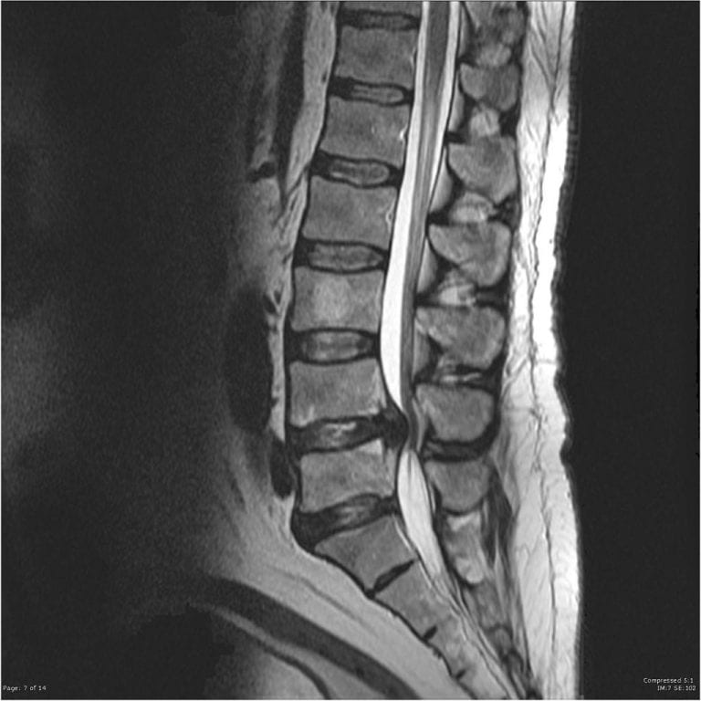 Cauda Equina Syndrome Rebel Em Emergency Medicine Blog