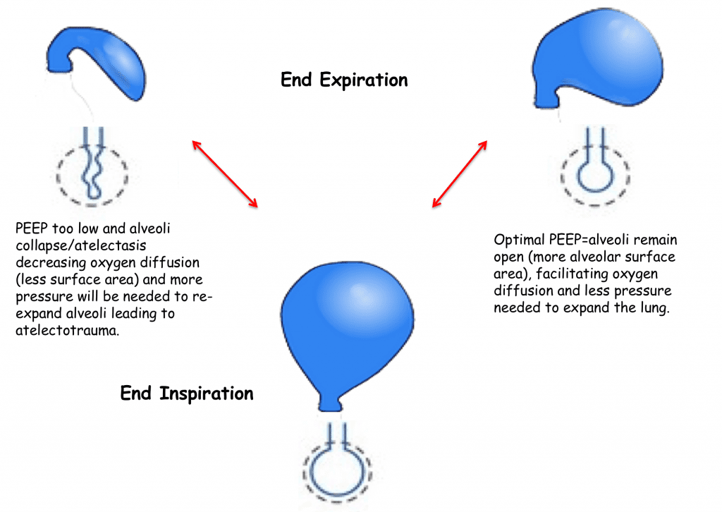 Simplifying Mechanical Ventilation Part 2 Goals Of Mechanical 