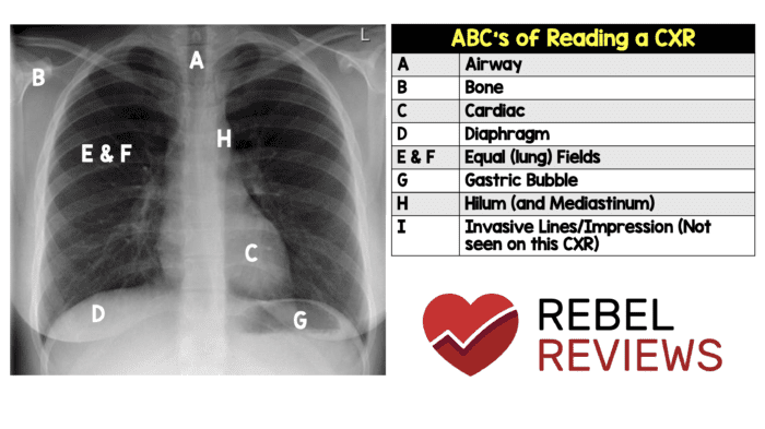 ABCs Of Reading A CXR REBEL EM Emergency Medicine Blog