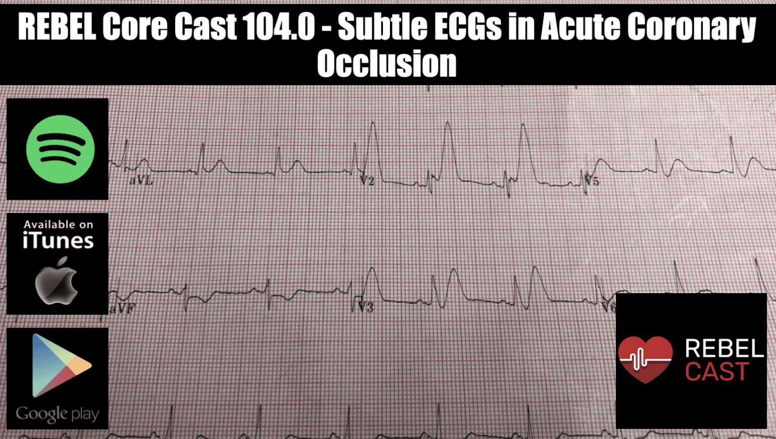 REBEL Core Cast 104 0 Subtle ECGs In Acute Coronary Occlusion REBEL