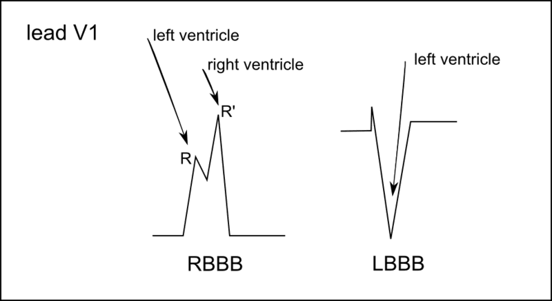 RBBB and LBBB