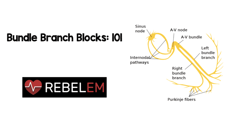 Bundle Branch Blocks: 101 - REBEL EM - Emergency Medicine Blog