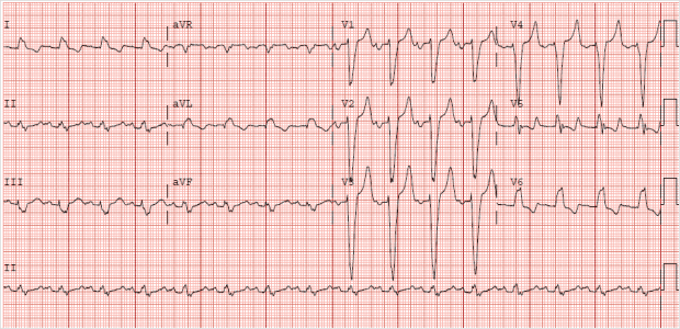 Bundle Branch Blocks: 101 - R.E.B.E.L. EM - Emergency Medicine Blog