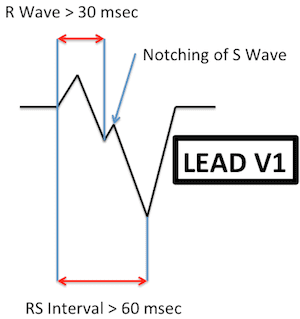 Notching of S Wave in Lead V1