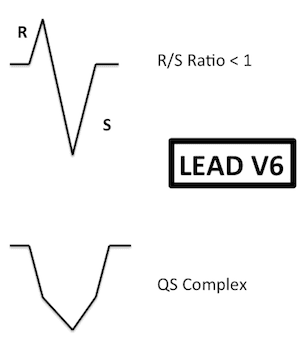 Lead V6 RBBB Morphology in Ventricular Tachycardia