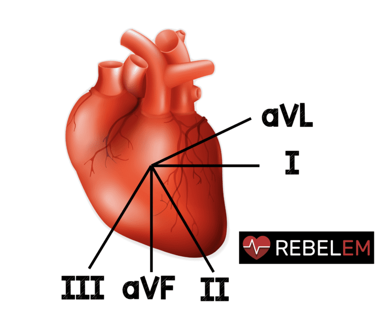 The Importance of Reciprocal Changes in aVL - REBEL EM - Emergency ...