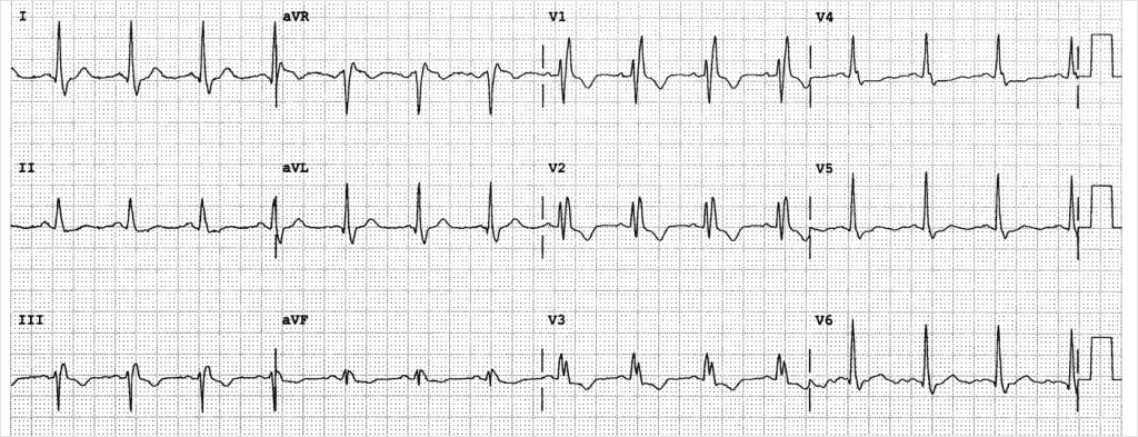 Bundle Branch Blocks: 101 - REBEL EM - Emergency Medicine Blog