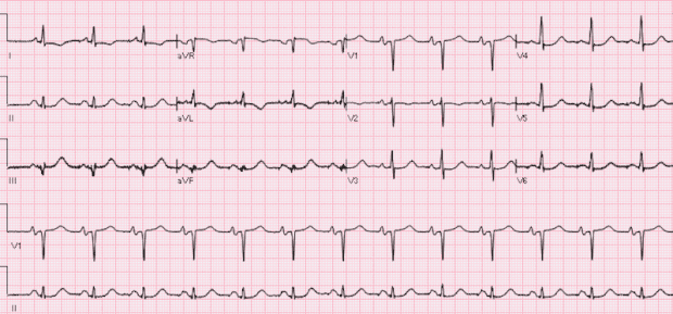 REBEL ECG of the Week #5 - REBEL EM - Emergency Medicine Blog