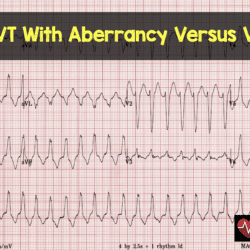 SVT With Aberrancy Versus VT – MED-TAC International Corp.