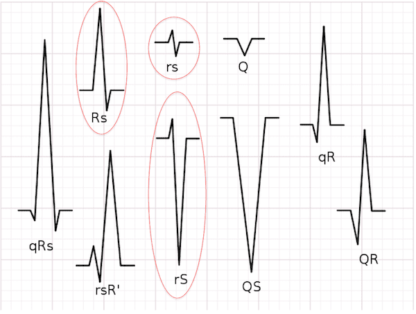 Absence of RS Complex in Precordial Leads