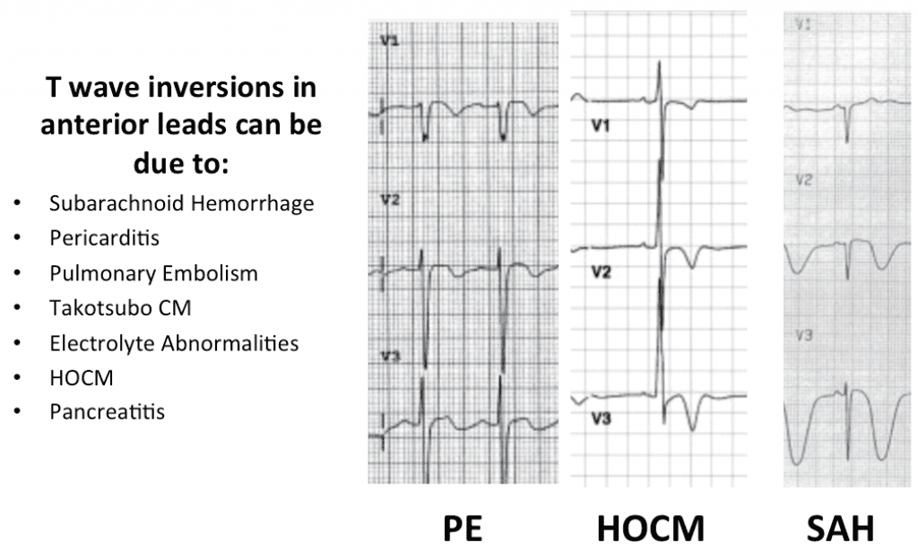 T-Wave Inversions Not Caused by Wellens' Syndrome