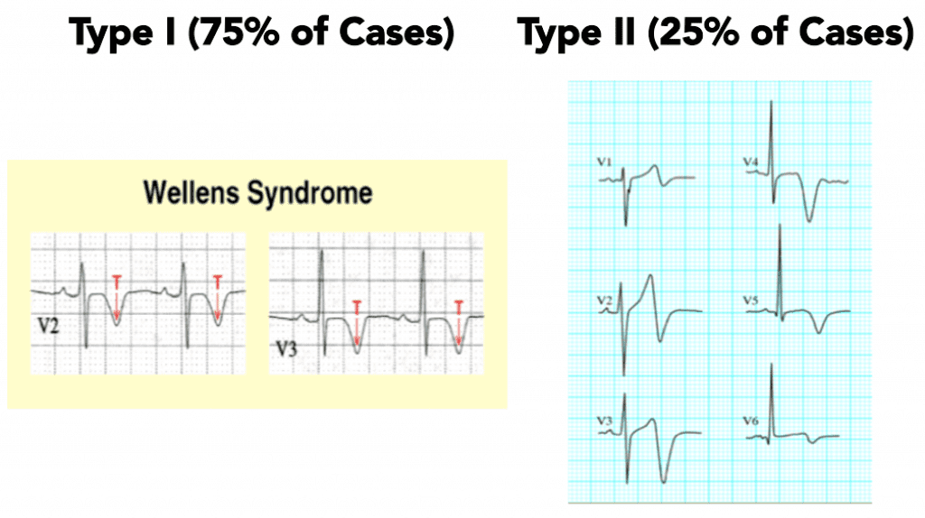 Wellens' Syndrome Type 1 and Type 2