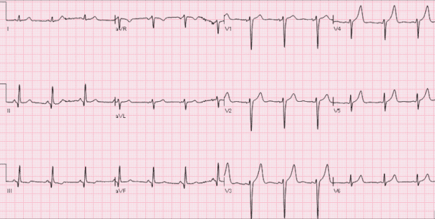 REBEL ECG of the Week #6 - REBEL EM - Emergency Medicine Blog