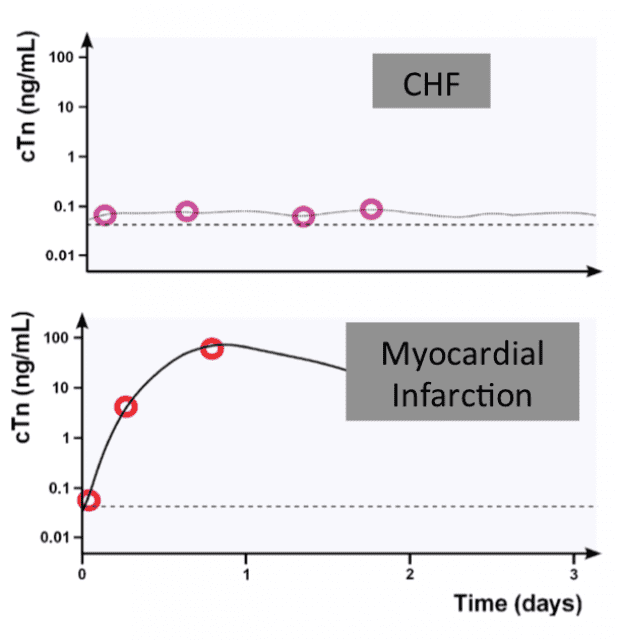 High Sensitivity Troponin Testing - REBEL EM - Emergency Medicine Blog