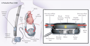 Left Ventricular Assist Device - REBEL EM - Emergency Medicine Blog