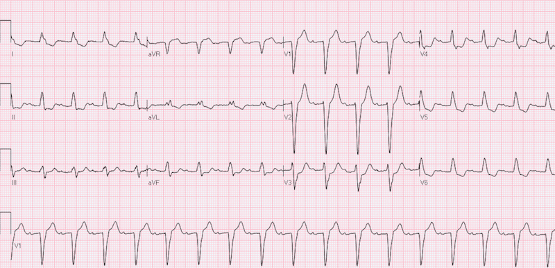 R.E.B.E.L. ECG of the Week: LBBB and STEMI