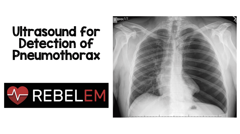 Ultrasound For Detection Of Pneumothorax Rebel Em Emergency Medicine Blog
