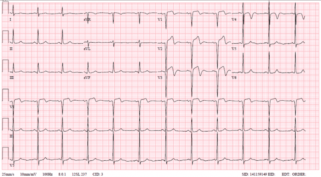 Wellens' Syndrome or STEMI