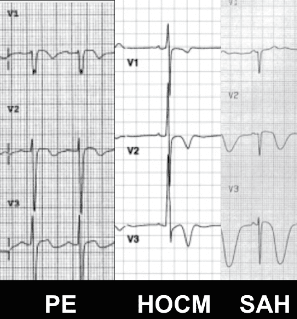 R.E.B.E.L. ECG of the Week: Wellens' Syndrome or STEMI - T Wave Inversion in Anterior Leads