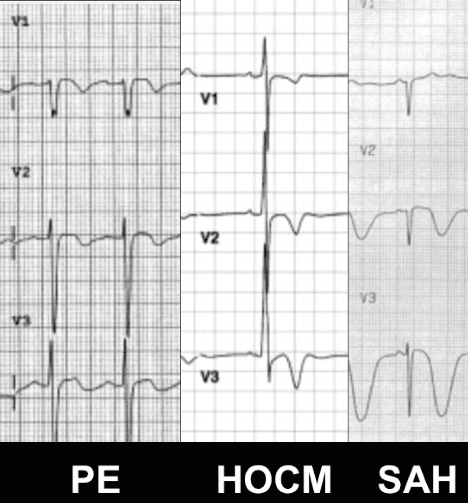 REBELDE. ECG de la semana: Síndrome de Wellens o STEMI - Inversión de la onda T en derivaciones anteriores