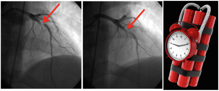 Ticking Time Bomb - REBEL EM - Emergency Medicine Blog