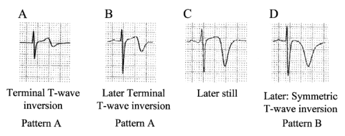 REBEL ECG of the Week #8 - REBEL EM - Emergency Medicine Blog