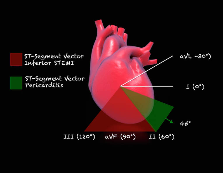 Inferior STEMI vs Pericarditis - REBEL EM - Emergency Medicine Blog