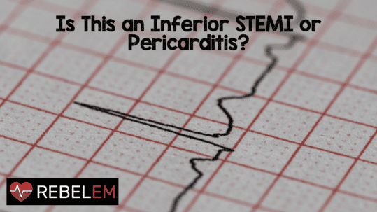 Is This an Inferior STEMI or Pericarditis? - REBEL EM - Emergency ...