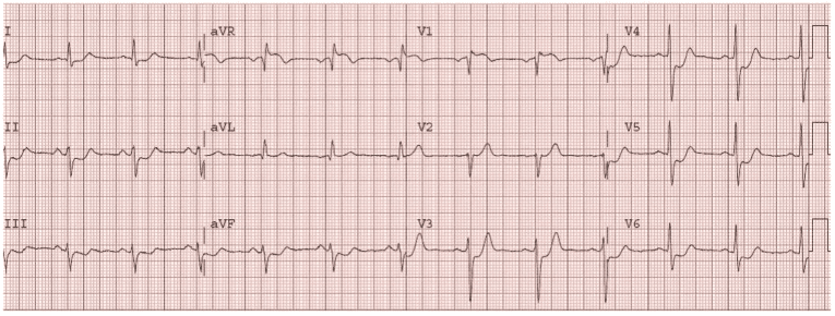 Five ECG Patterns You Must Know - REBEL EM - Emergency Medicine Blog