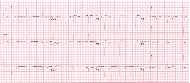 Five ECG Patterns You Must Know - REBEL EM - Emergency Medicine Blog