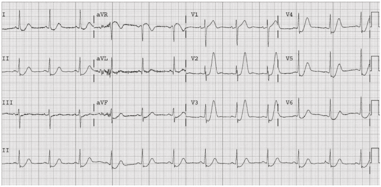 Five ECG Patterns You Must Know - REBEL EM - Emergency Medicine Blog