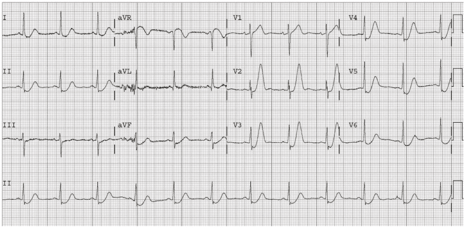 Five ECG Patterns You Must Know - REBEL EM - Emergency Medicine Blog