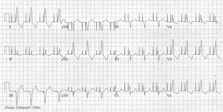 Pacemaker Basics - REBEL EM - Emergency Medicine Blog