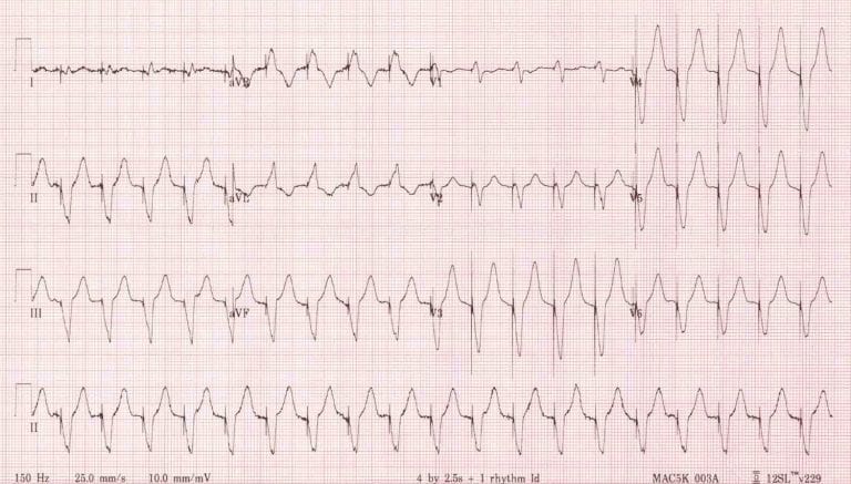 Pacemaker Mediated Tachycardia (LITFL) - REBEL EM - Emergency Medicine Blog