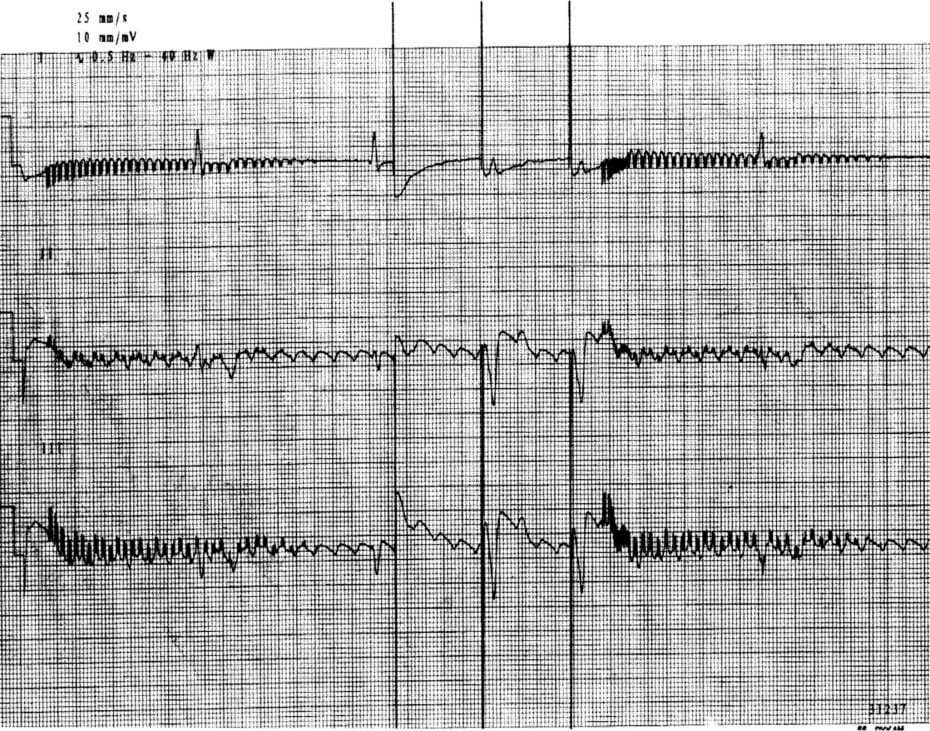 What Causes Pacemaker Syndrome at Mattie Watters blog