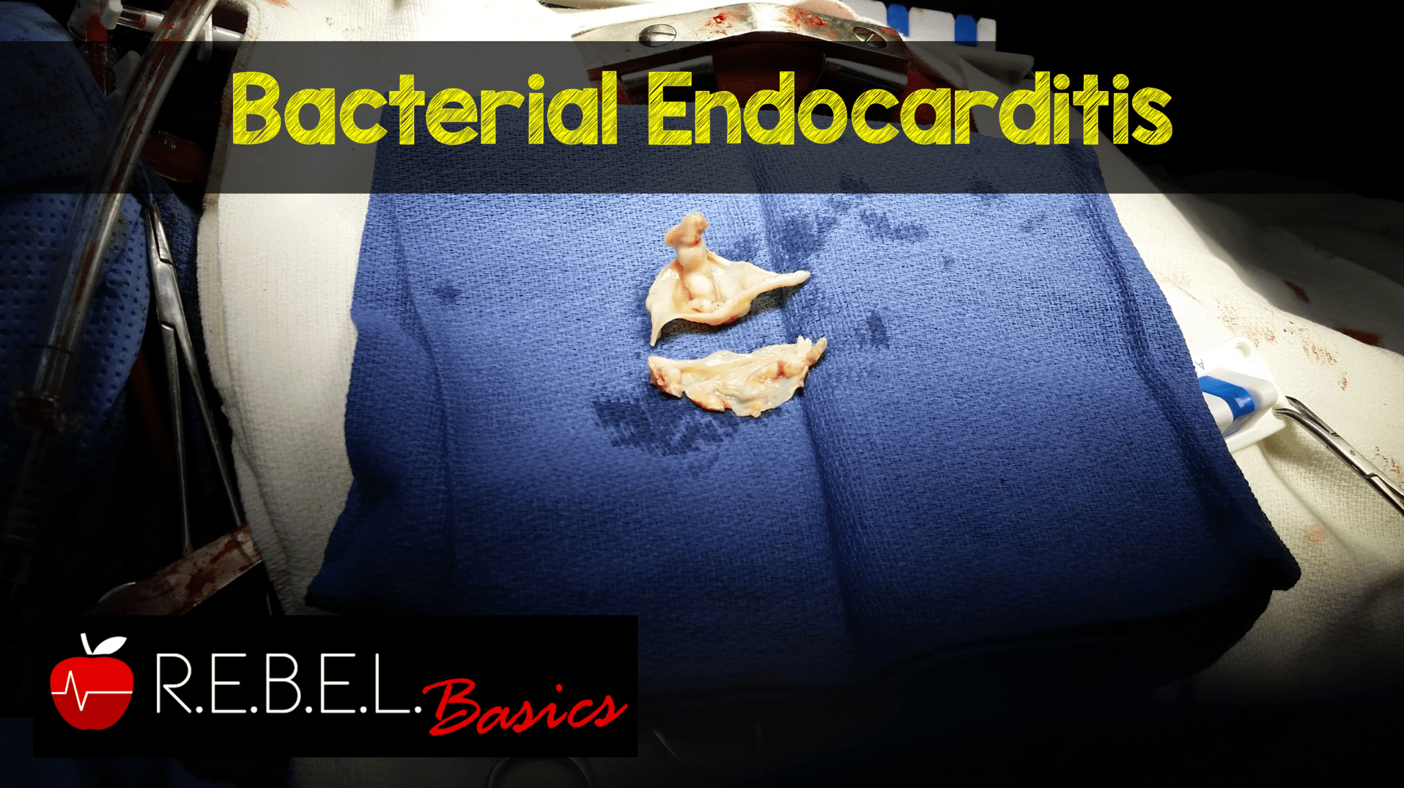 infective endocarditis tee