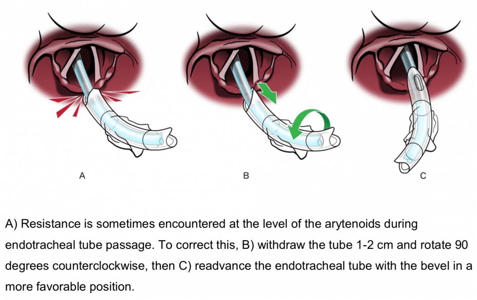Bougie use in Emergency Airway Management (BEAM) REBEL EM Emergency