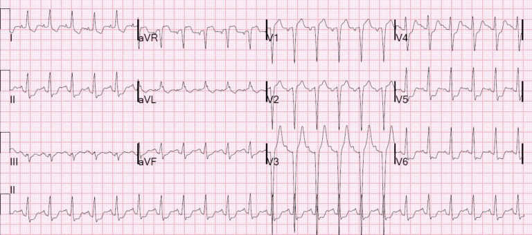 Rebellion in EM 2018: STEMI Equivalents by Tarlan Hedayati, MD - REBEL ...