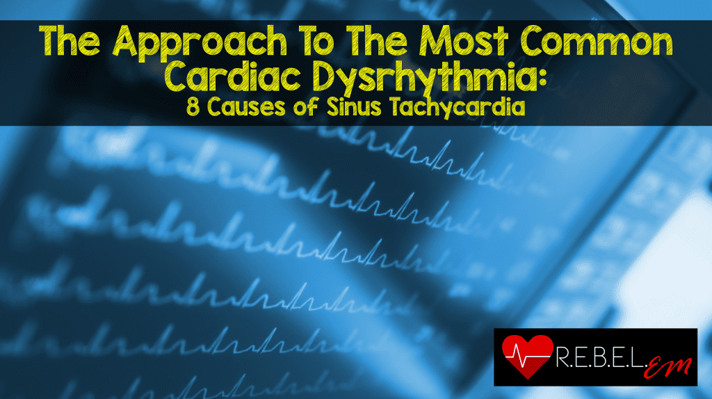 The Approach To The Most Common Cardiac Dysrhythmia 8 Causes Of Sinus Tachycardia Rebel Em Emergency Medicine Blog
