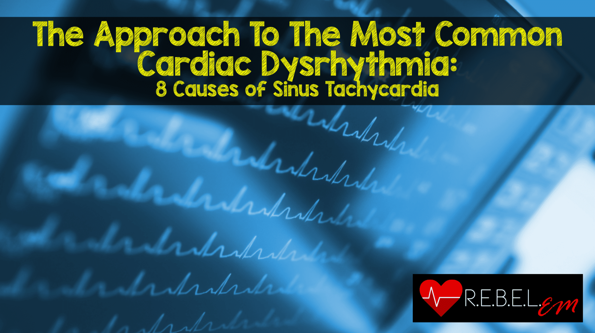 the-approach-to-the-most-common-cardiac-dysrhythmia-8-causes-of-sinus