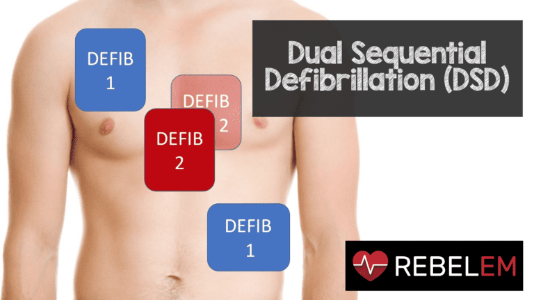 Dual Sequential Defibrillation (DSD) - REBEL EM - Emergency Medicine Blog